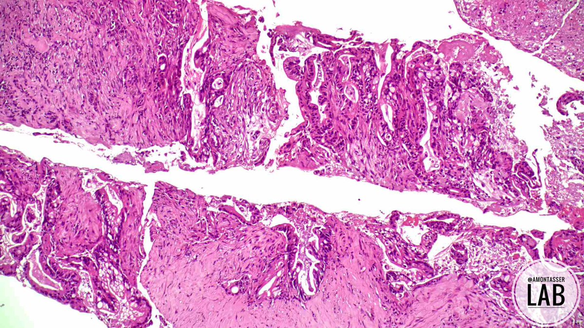 4• Distal CBD cholangiocarcinoma infiltrating duodenal wall