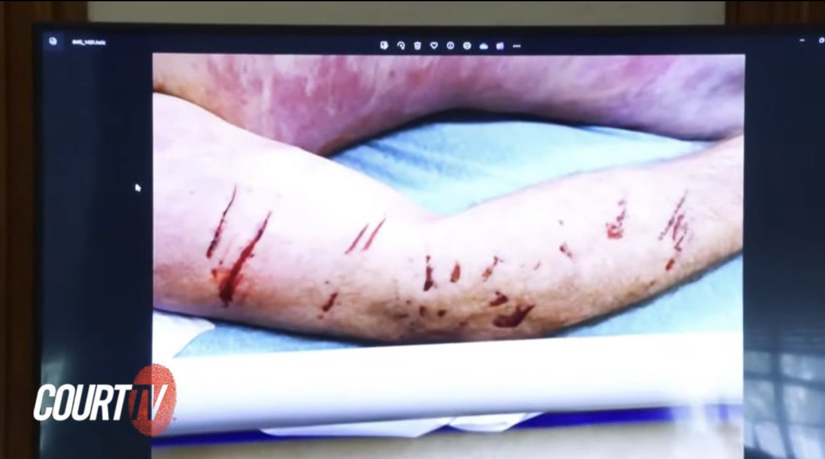 You know the prosecution’s case is going horribly when the defense enters autopsy photos into the record during their case in chief, displaying Officer #JohnOKeefe’s arm with what first responders have described as “scratches”, “furrows” and “lacerations”.
#KarenReadTrial…