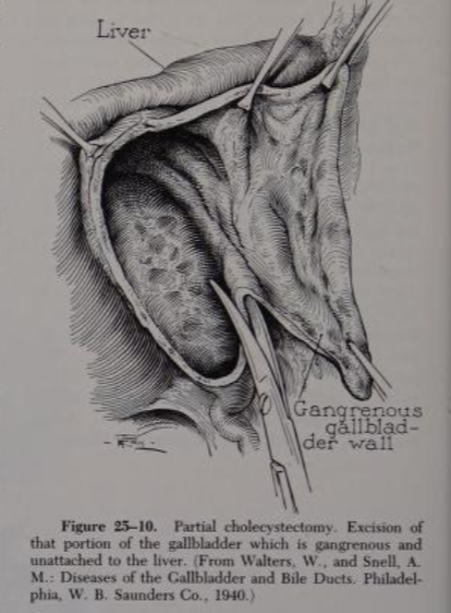 1940 drawing of what appears to be an open subtotal fenestrating cholecystectomy (here called a 'partial cholecystectomy'). From book by Waltman Waters in 1940. Waters was from Mayo and was chief editor of Archives of Surgery (which later became JAMA Surgery).