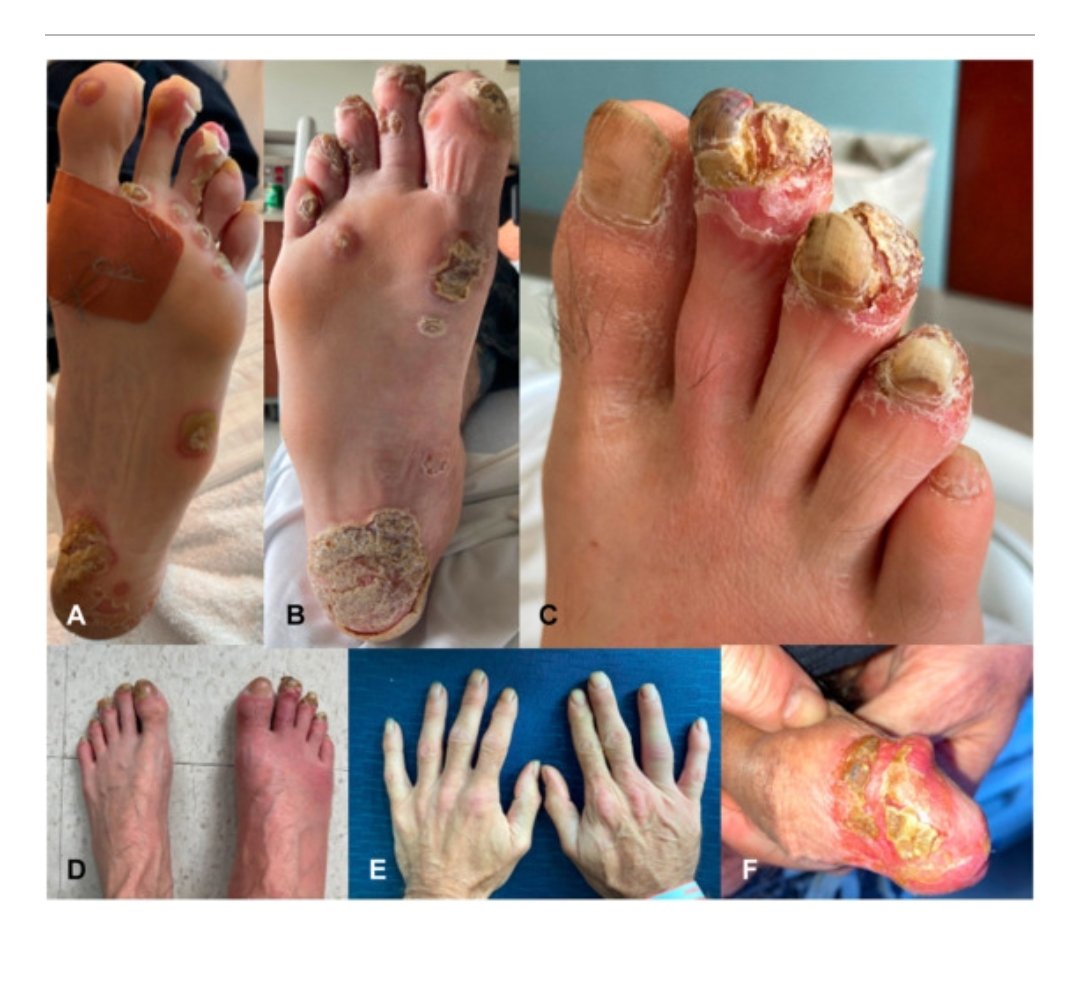 🚨 Warning- graphic images
Reactive arthritis following Pfizer  BNT162b2
49 year old previously healthy male. 
Clinical images taken upon admission to the hospital. A and B, Papulopustules and hyperkeratotic plaques on the plantar aspects of the feet. C, Onychodystrophy of the…