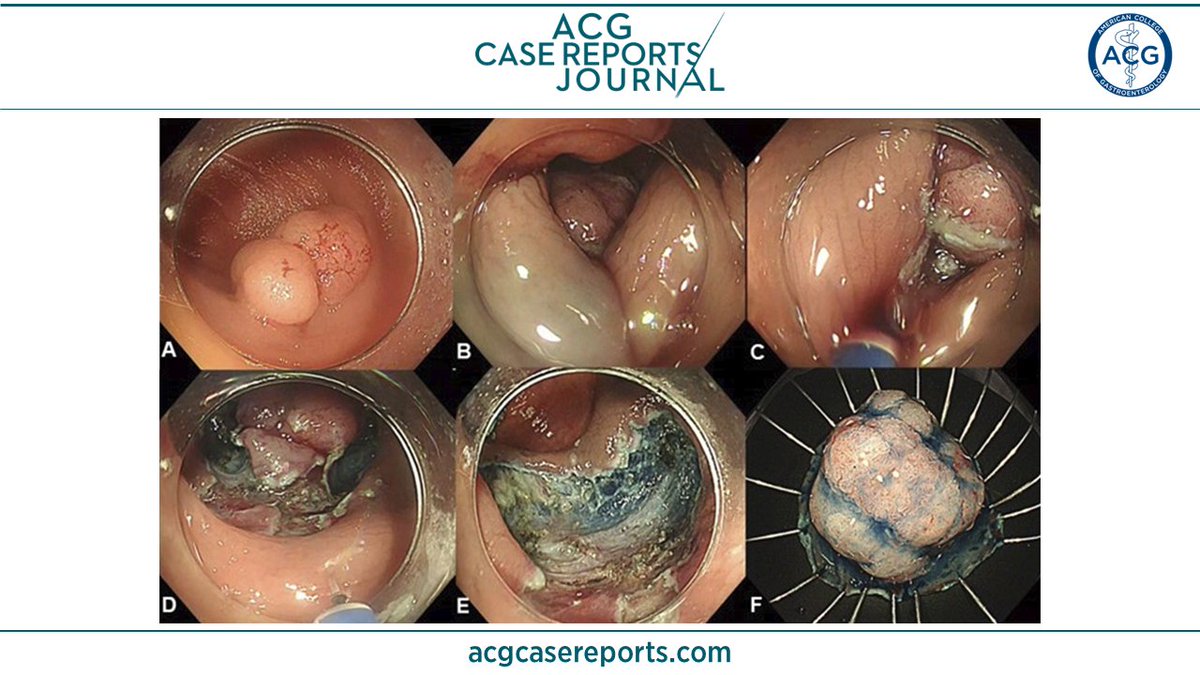 🔎 ACG Case Reports Journal 🔍 Video: Incision Technique for Flattening the Elevated Mucosa due to Excess Local Injection During Colorectal Endoscopic Submucosal Dissection Yoshimoto, et al. 👉 bit.ly/3y25F2d #GIfellows @KhushbooSGala @VibhuC_MD