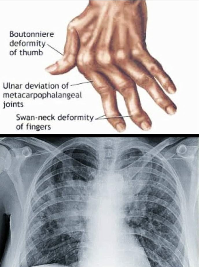 📝𝘾𝙇𝙄𝙉𝙄𝘾𝘼𝙇 𝙌𝙐𝙄𝙕

#Rheumatoid Arthritis complicated by pneumoconiosis is known as :-

(A) Goodpasture syndrome
(B) Caplan syndrome
(C) Cystic Fibrosis
(D) Marfan syndrome 

#medx 
#MedTwitter #Mcqs