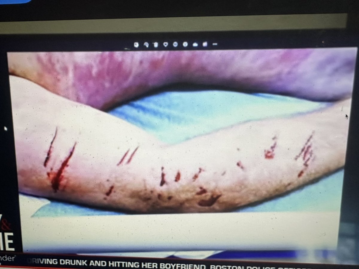 As someone who has shown dogs for 20 years that’s a dog bite. I mean I came into this not knowing the story but this IS a dog bite or that car self identifies as a dog. #KarenReadTrial