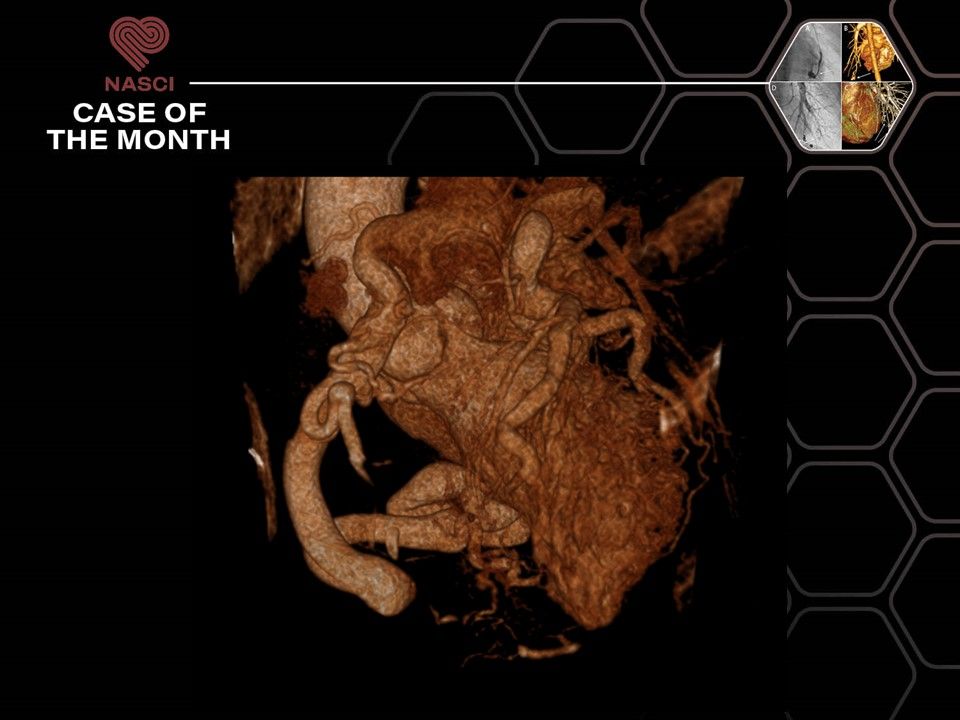 The #NASCI Case of the Month: A Case of Anomalous Right Coronary Artery Arising from the Pulmonary Artery has been published in the @IJCVImaging! Read the full case report here: buff.ly/3UKevdR #cardiovascularimaging @JRevRad1 @ShaimaaFadl1 @AwsHamid5 @LubaFrank11