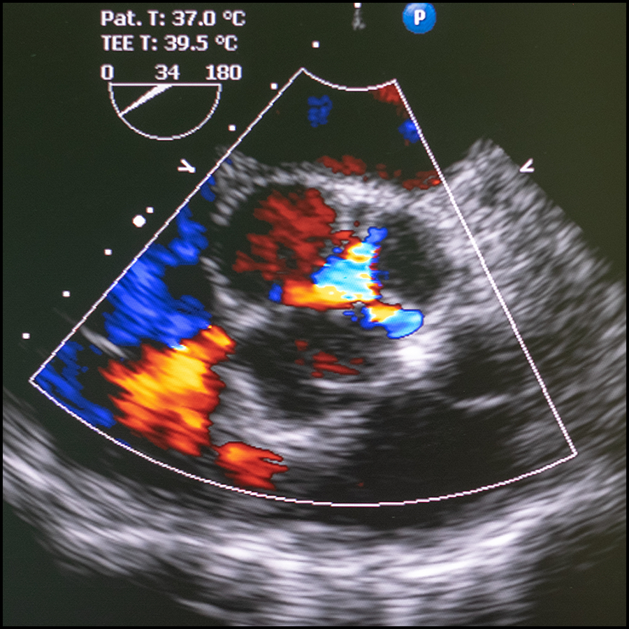 A five-year follow-up of patients with severe, symptomatic aortic stenosis at low surgical risk recruited to a trial of TAVR versus surgery reported no significant between-group difference in two primary composite outcomes. Read the May 2024 SM&A: ow.ly/tEHH50RvaIn