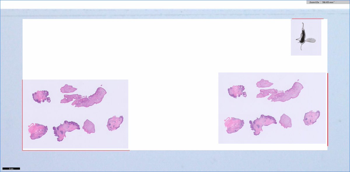 me (texting resident): Dx on TURBT case X level A1-2?

res: 🤨

me: stay lowpower so you don't fly over the focus

res: 😳

me: it's okay if you're not sure, just wing the Dx

res:😬

me: no worries, don't let it bug you

res:😑

#dadjokes when #GUpath meets #IDpath