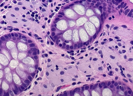 USGIPS's tweet image. What do all of these beautiful cases have in common besides being found in the most exciting organ system of the body? They have all been featured as one of our Cases of the Month! Interested in sharing a case with a worldwide audience? 👀⬇️ #GIPS #GIpath