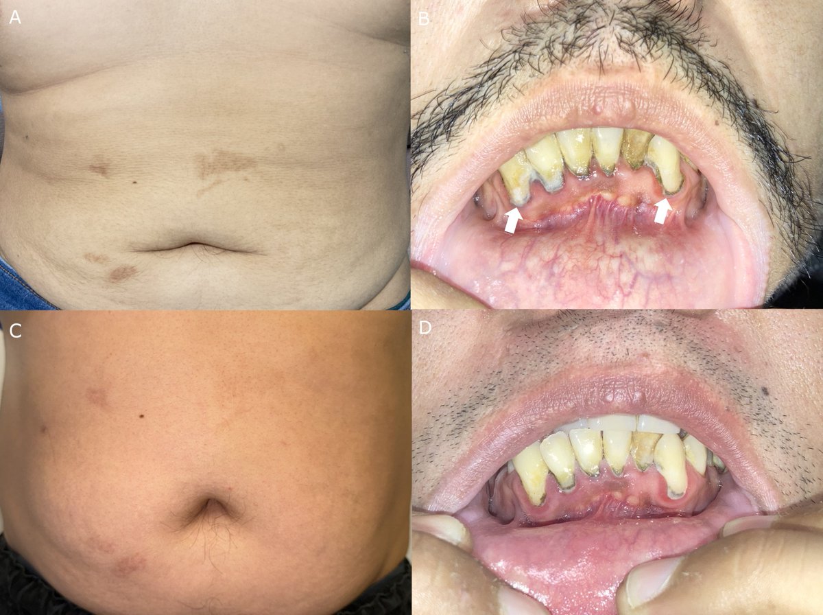Clinical Image: Burton’s line and scar hyperpigmentation in a patient with severe lead poisoning and saturnine gout A 35-year-old man with a 3-year history of gout, presented with a 2-month history of abdominal pain and altered mental status In A&R loom.ly/3jEjKeI