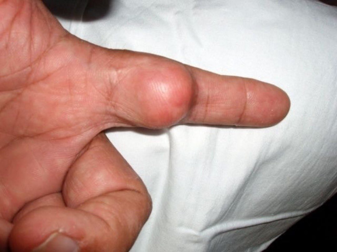 A patient presented for further evaluation of a mass in his finger. He mentioned that it began a year ago but had been bothering him lately. Exam w/fluctuant swelling. Diagnosis? A. Lipomas B. Neuromas C. Epidermal Inclusion Cyst D. Squamous cell carcinoma of the skin