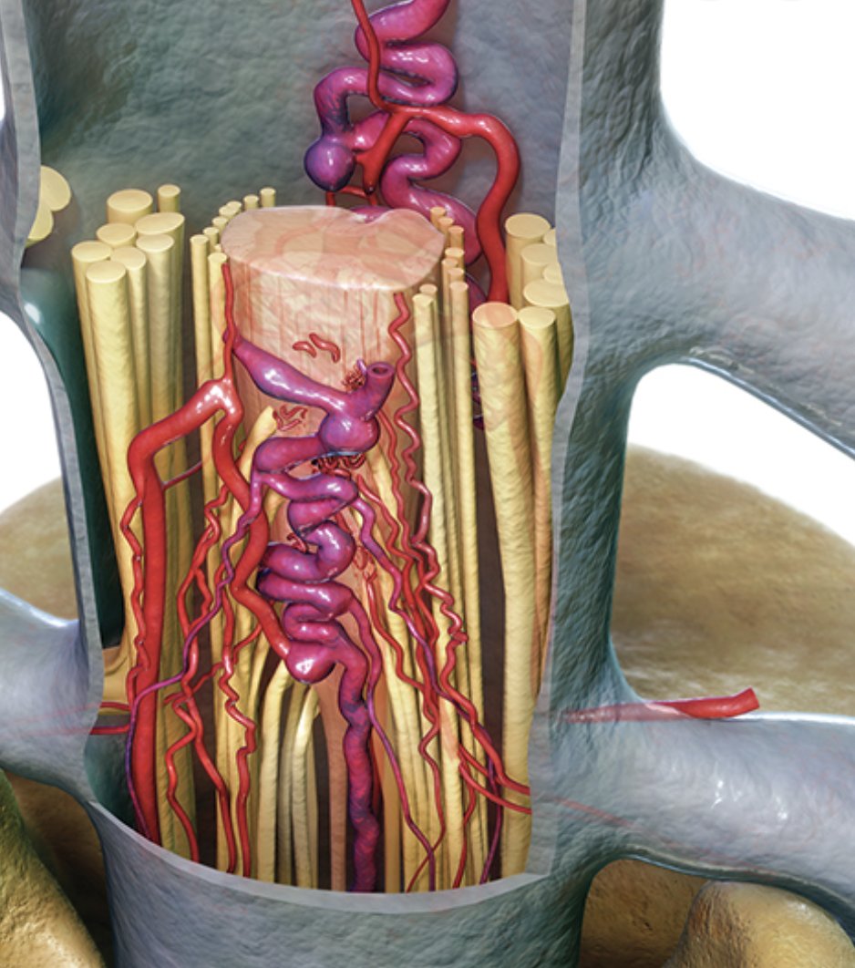 Watch the Seven Series video showing this laminectomy, in situ occlusion of a conus medullaris spinal arteriovenous malformation, on our website @BarrowNeuro by clicking on this link…Bar.rw/7series