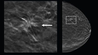 Using #AI system, general radiologists performed at the level of unaided breast imaging specialists doi.org/10.1148/ryai.2… @UWRadiology @uwsph @DanaFarber #DeepLearning #MammoRad #DBT