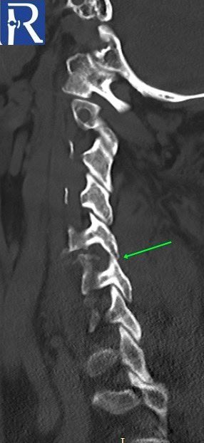 . Additionally, there is mild associated rotatory subluxation without dislocation of the left facet joint (indicated by the green arrow).#radiology #mskrad #radtwitter #neurosurgery #Emergencyradiology #radres