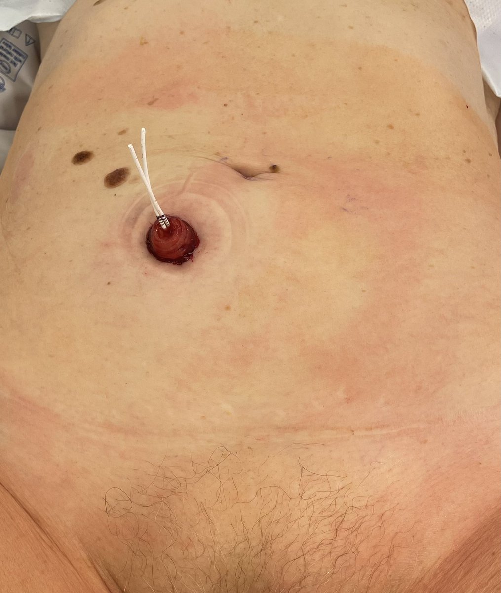 Mutahar Ahmed (@roboticsurology) on Twitter photo Complex PN SP LAA video well received glad pro <a href="/drjkaouk/">Dr. J. Kaouk</a> and semi con <a href="/JamesPorterMD/">James Porter</a> was there for lively discussions ..the AUA video robotic theater was filled with exciting technique including our SP no incision single port cystectomy #AUA2024 <a href="/AmerUrological/">Amer. Urol. Assn.</a> <a href="/HUMCUrology/">HackensackUMC Department of Urology</a> Complex PN SP LAA video well received glad pro <a href="/drjkaouk/">Dr. J. Kaouk</a> and semi con <a href="/JamesPorterMD/">James Porter</a> was there for lively discussions ..the AUA video robotic theater was filled with exciting technique including our SP no incision single port cystectomy #AUA2024 <a href="/AmerUrological/">Amer. Urol. Assn.</a> <a href="/HUMCUrology/">HackensackUMC Department of Urology</a>