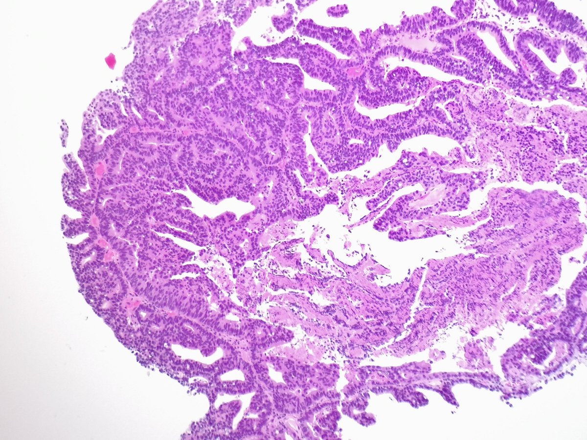 HG papillary urothelial carcinoma with divergent glandular differentiation.
🚨Pitfall: with this 🔬 appearance, always r/o prostatic ductal ADC ➡️ major tx difference.
#IHCpath helps.
➕GATA3, p63
➖NKX3.1

#GUPath #PathTwitter