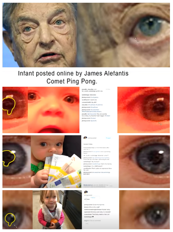 Did you know that George Soros has Coloboma, a rare genetic condition that only 1 out of every 10K children are born with?

Being that bloodlines (for various reasons) are rather impt to the globalist cabal it's certainly worthy of scrutiny.

What's odd is that neither of