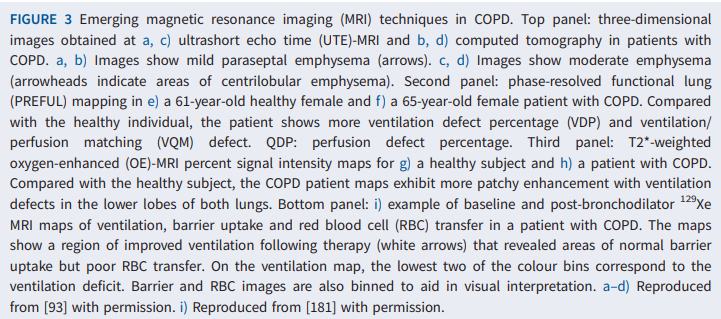 What are the advances in #lung #imaging? A beautiful review @ERSpublications A picture is worth a thousand words (or in this case p-values!) bit.ly/4aivrgo