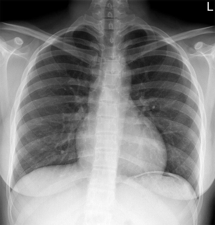 Patient with abdominal pain. Which statement is true? A. Chest X-rays are not used in the context of acute abdominal pain B. There is free intra-abdominal gas visible under the left hemidiaphragm C. There is free intra-abdominal gas visible under the right hemidiaphragm D. There…