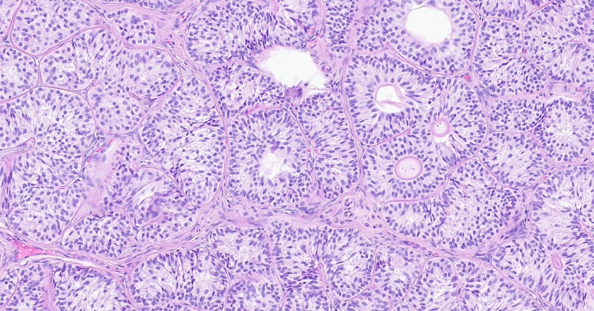 Sertoli cell nodule #gupath# testicular pathology.