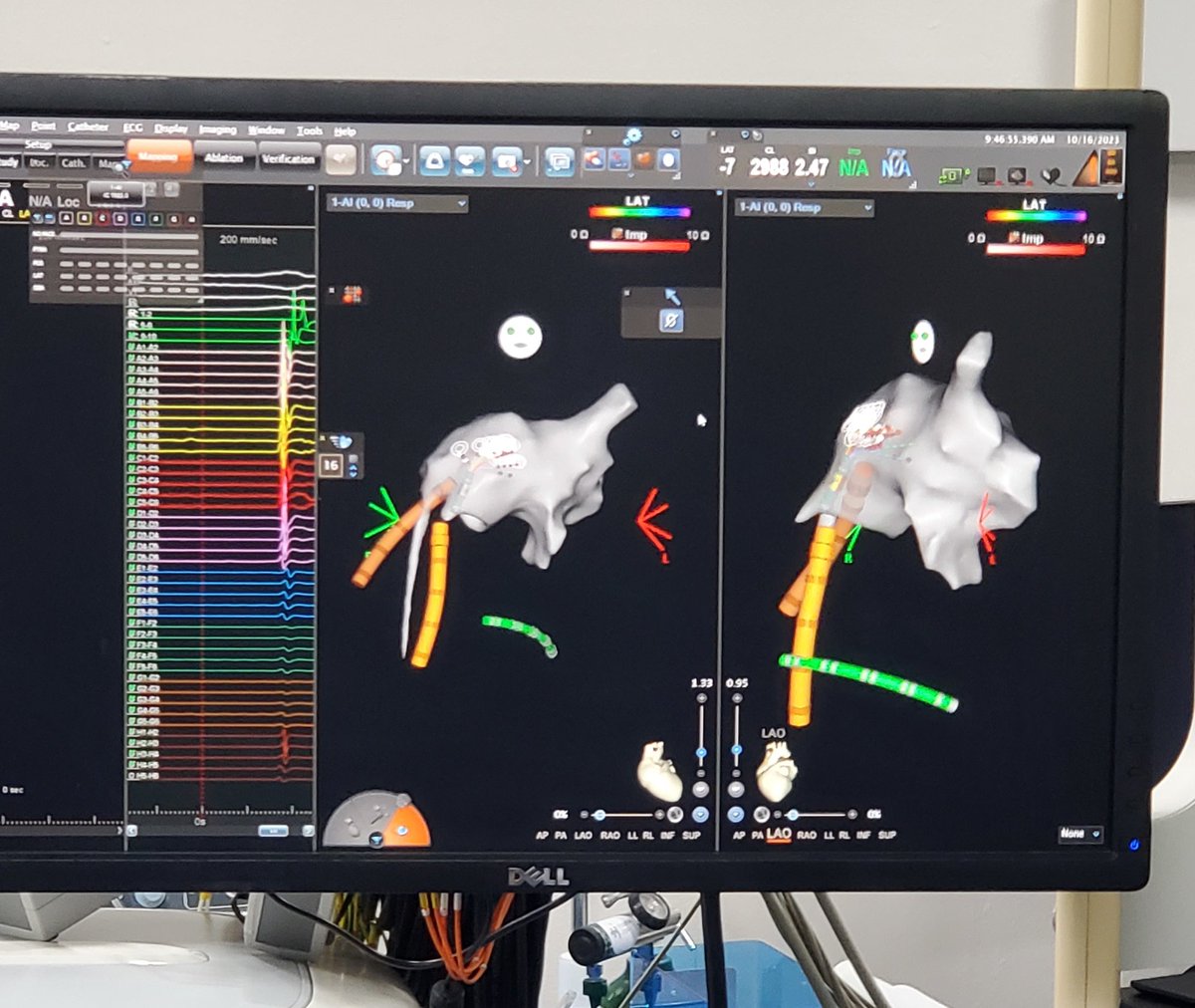 MonarchHeart_'s tweet photo. Heart medications? Abnormal heart beats? Heart flutter?Afib? Heart arrhythmia of another kind? A procedure called CARDIAC ABLATION may be the answer. Connect with experienced cardiologists in Puerto Vallarta Mexico who can help. 
https://t.co/MnVA2SNqlo
#afib https://t.co/IGqQO5hmJ7