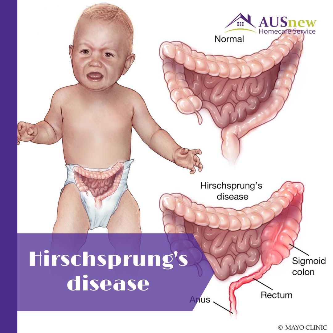 ⚜️In Hirschsprung's disease (HIRSH-sproongz), bowel incontinence affects the colon. The infant's colonic musculature lacks nerve cells, making the disease congenital. Source: Mayo Clinic #hirschsprungsdisease #pathologicalcondition