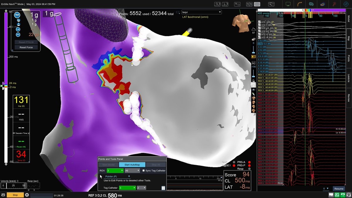 Enf_mauss's tweet photo. Anterolateral AP, mapped by Dr. @imelinadelao w/ #HDgrid &amp; #omnipolar, eliminated in less than 2 sec 🔥 with #tacticath.
@AbbottCardio 
#EPteam #Epeeps #EnsiteX https://t.co/SfjiP2ouzl