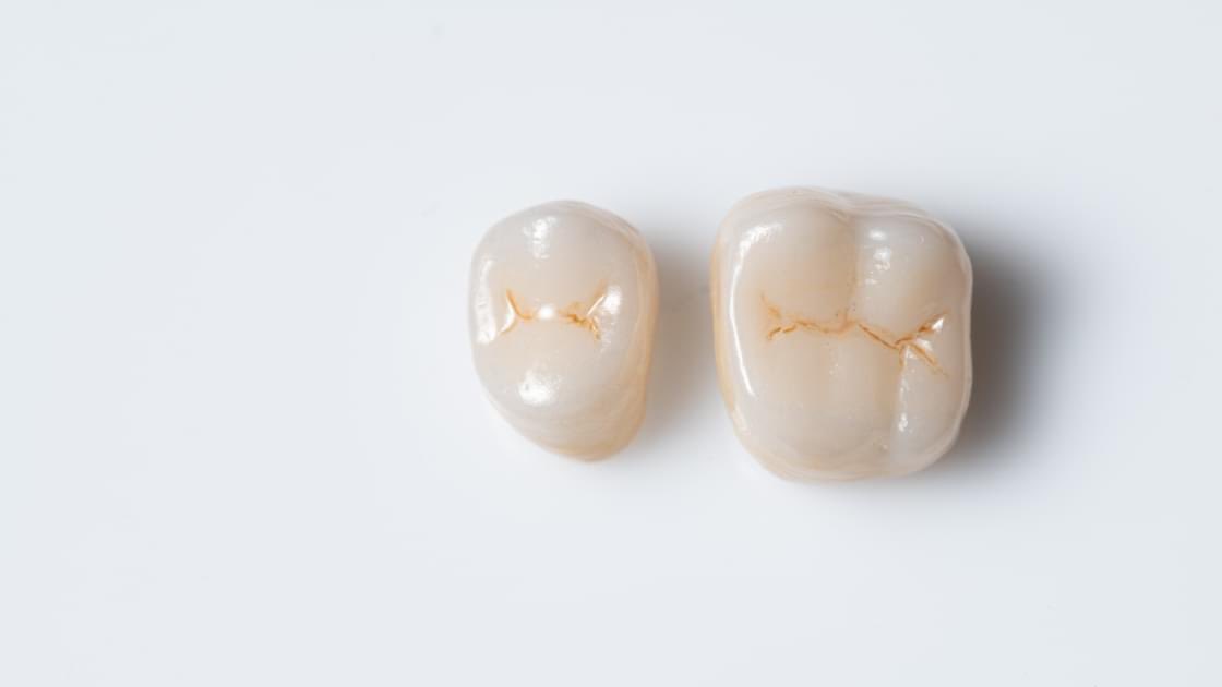 Swinney Dental provides crowns and bridges to help repair your smile. To schedule an appointment, contact 903-213-5818 right now. s.tnycc.com/vOH4Kk