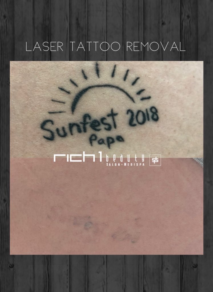 One more session & we should be done!
.
.
.
#tattooremoval #tattoo #laser #lasertattooremoval #cynosure #nanaimo #vancouverisland #microblading #tattoos #permanentmakeup #skin #lasertreatment #tattooregret #brows #eyebrows  #pmu #tattooremover #zimmer #zimmerchiller
