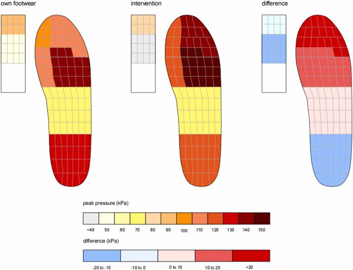 Effectiveness of footwear and foot orthoses in reducing medial metatarsophalangeal joint pressure in women with hallux valgus sciencedirect.com/science/articl…