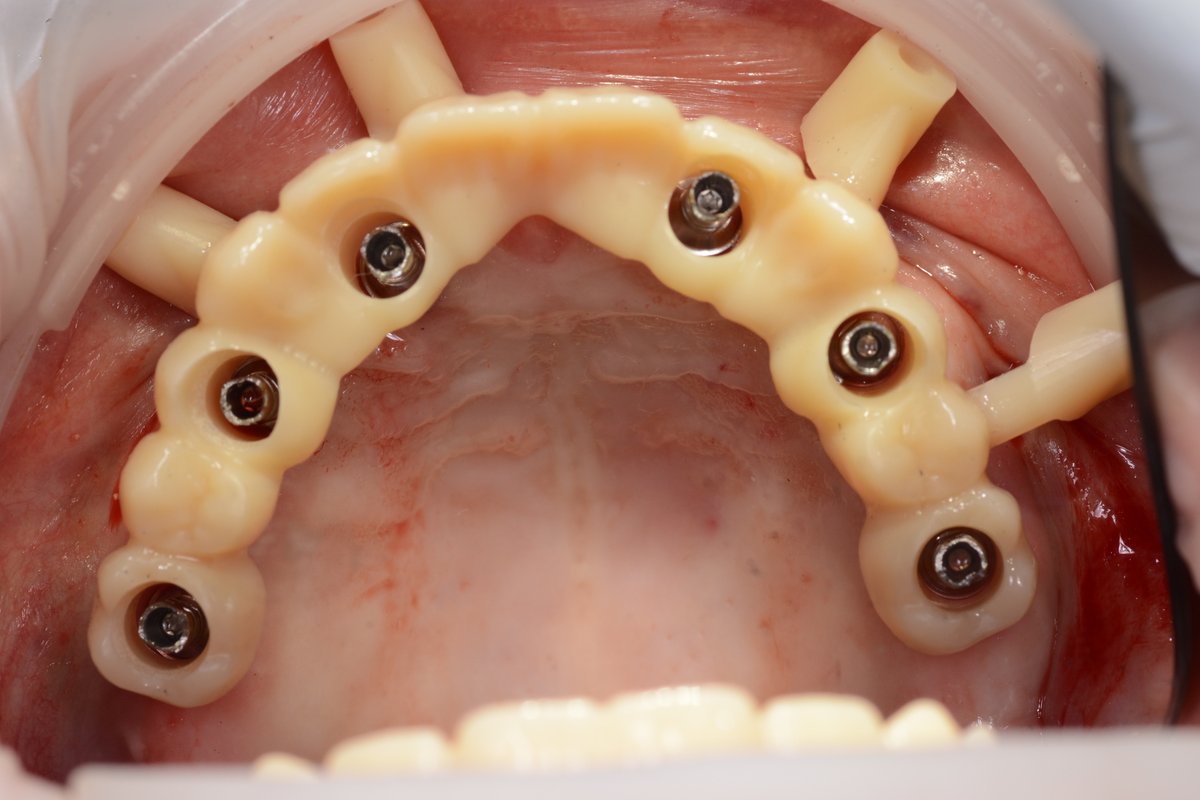 Sex is good, but have you ever had that feeling when a provision fits perfectly into the implants in a full-arch restoration planned with <a href="/straumann/">Straumann</a> Smile in a Box?

Teamwork with Ariel Labanca, Bruno Kauer, and Sergio Cacciacane.