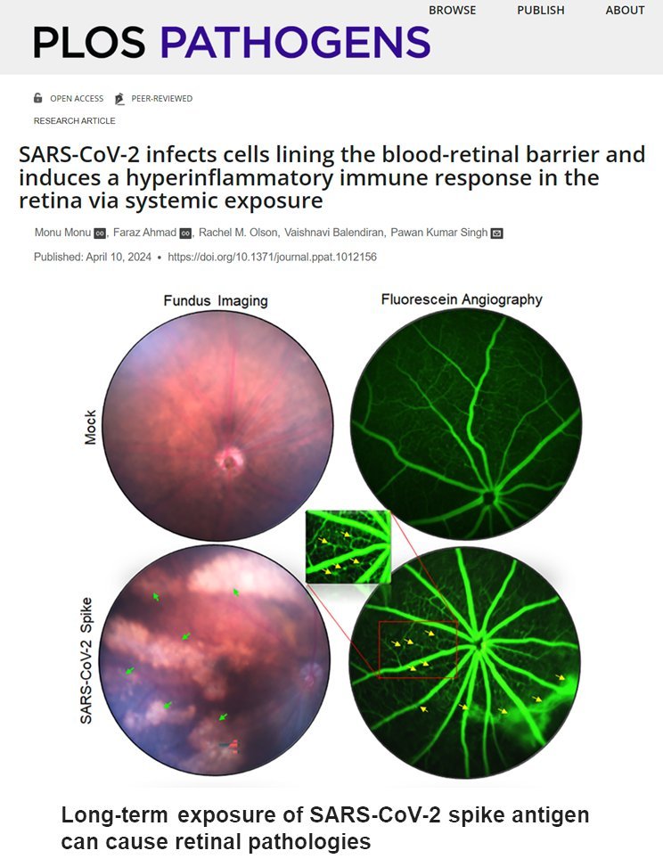 @StoneColdPillar @NEJM @VirusesImmunity @zalaly @BatemanHorne @RTHM_Health Oh yeah, there are increasing reports of alterations in the optic nerve, intraretinal hemorrhages, and overall retinal vessel modifications. Since SARS-CoV-2 disrupts many blood vessels and the retina is highly vascularized, these problems are not uncommon.