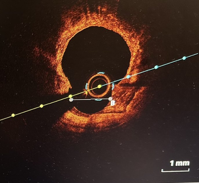 GutoDallan (@gutodallan) on Twitter photo Grateful to @scai for opportunity in Live Case from Cleveland @harringtonHVI <a href="/UHhospitals/">University Hospitals</a> for #SCAI2024 Long Beach-CA. With amazing CTO specialist <a href="/the_real_pooms/">the_real_pooms</a> & IC fellows, we demonstrated heavily calcified lesion modification #Radial #OCT #Rotablator #CHIP #UHproud <a href="/shishem/">Mehdi Shishehbor, DO</a> Grateful to @scai for opportunity in Live Case from Cleveland @harringtonHVI <a href="/UHhospitals/">University Hospitals</a> for #SCAI2024 Long Beach-CA. With amazing CTO specialist <a href="/the_real_pooms/">the_real_pooms</a> & IC fellows, we demonstrated heavily calcified lesion modification #Radial #OCT #Rotablator #CHIP #UHproud <a href="/shishem/">Mehdi Shishehbor, DO</a>