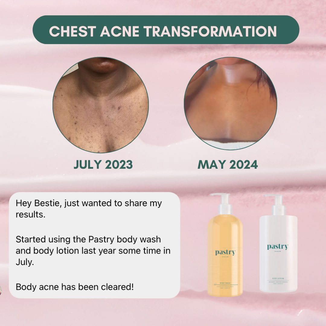 Our doll @/_halieo shows us how her chest acne has cleared using the Salicylic Acid Body Wash and Niacinamide Body Lotion ✨💚 This duo helps brighten your skin and reduce the appearance of stubborn blemishes. The Niacinamide Body Lotion restocking soon! 💚