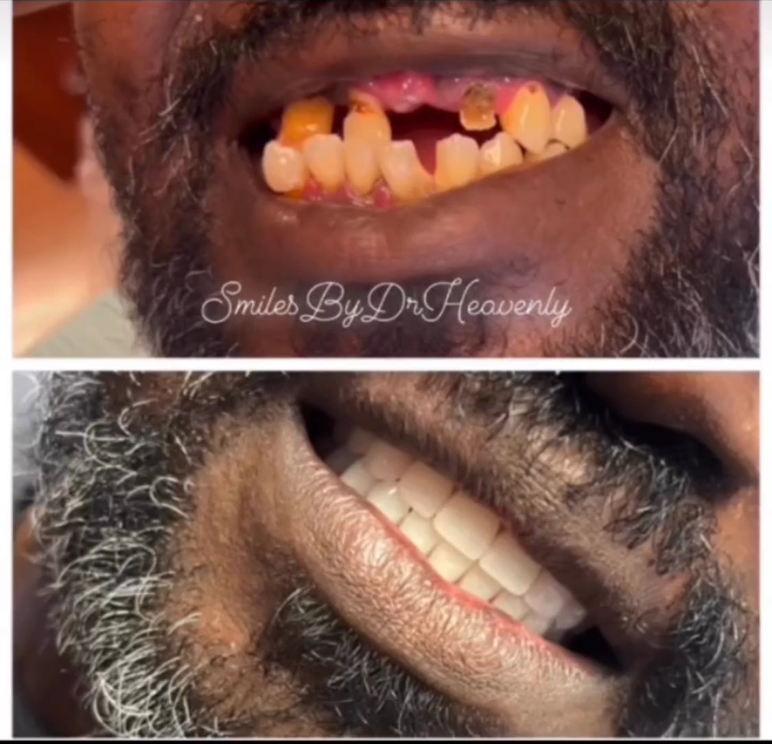 Please Leave the “veneer techs” alone!!! Dental caries is an infectious disease!!! It can kill you!!! Licensed professionals only!!! SmilesByDrHeavenly.com #LowMonthlyPayments #Married2med #DrHeavenly #DoctorOfDentalSurgery