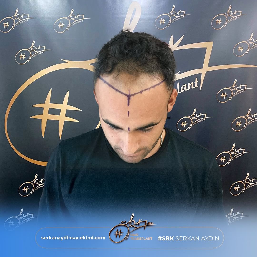 Natural Hairline Restoration with DHI Method 😎
#reşatözer
Contact us now for a Free Hair Analysis!

#serkanaydin #maximumgrafts #hairtransplant #beardtransplant #stemcell #haartransplant #Stammzellen #maximalgraft #maximaktransplantation #barttransplant