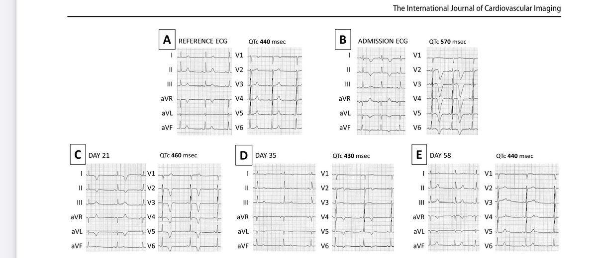 A patient presented with Takotsubo mimicking Apical HCM: the importance of the integrated and open minded approach when diagnosing cardiomyopathies. 

✔️Anamnesis, fx HX, ECG, echo, CMR and their temporal perspective and evolution are keys.

Have a read: 

doi.org/10.1007/s10554…