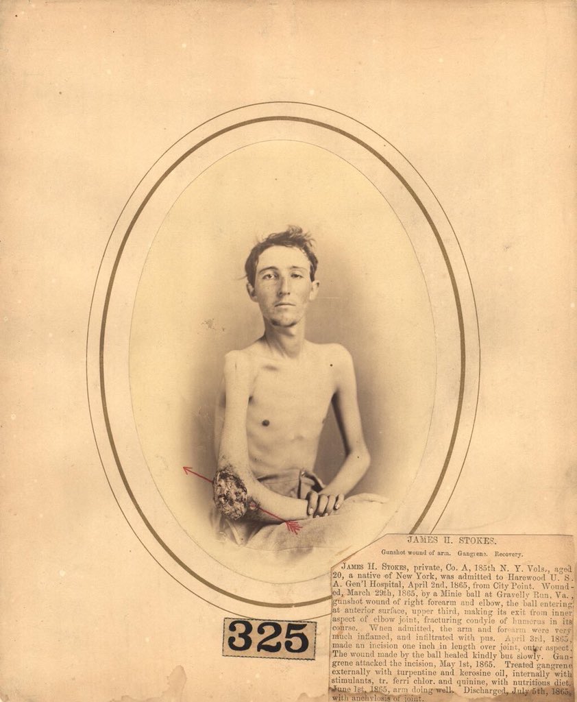 American Civil War solider with gangrenous wound of the elbow. #histmed #history #militarymedicine #historyofmedicine #pastmedicalhistory