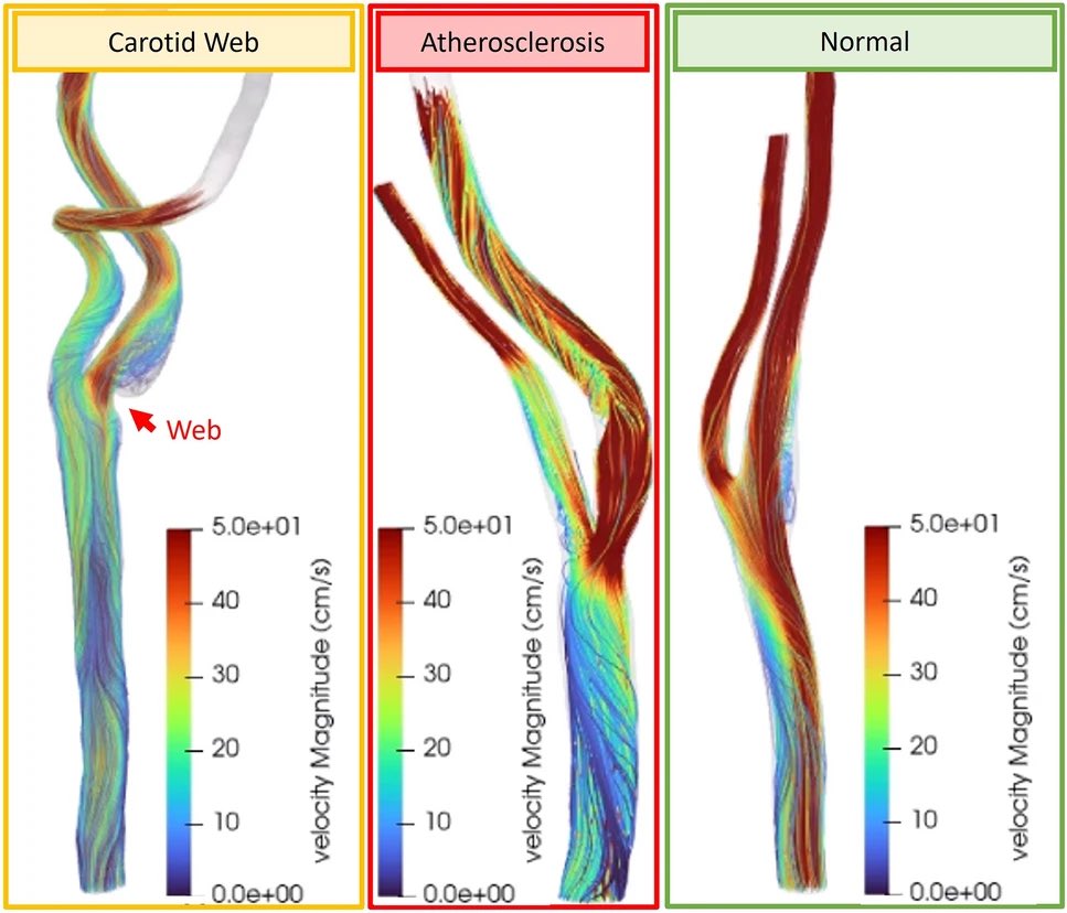 Subjects with carotid webs demonstrate pro-thrombotic hemodynamics compared to subjects with carotid atherosclerosis nature.com/articles/s4159…