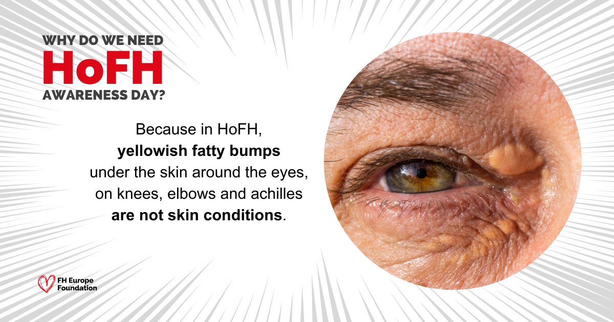 Untreated #HoFH can lead to xanthomas, which are fatty bumps under the skin. They tend to build up on elbows, Achilles tendon and even in sensitive areas, causing discomfort. #FindHoFH #Maythe4thbewithyou Learn more & #Unite4HoFH with @fhpatienteurope: bit.ly/4dph6kX