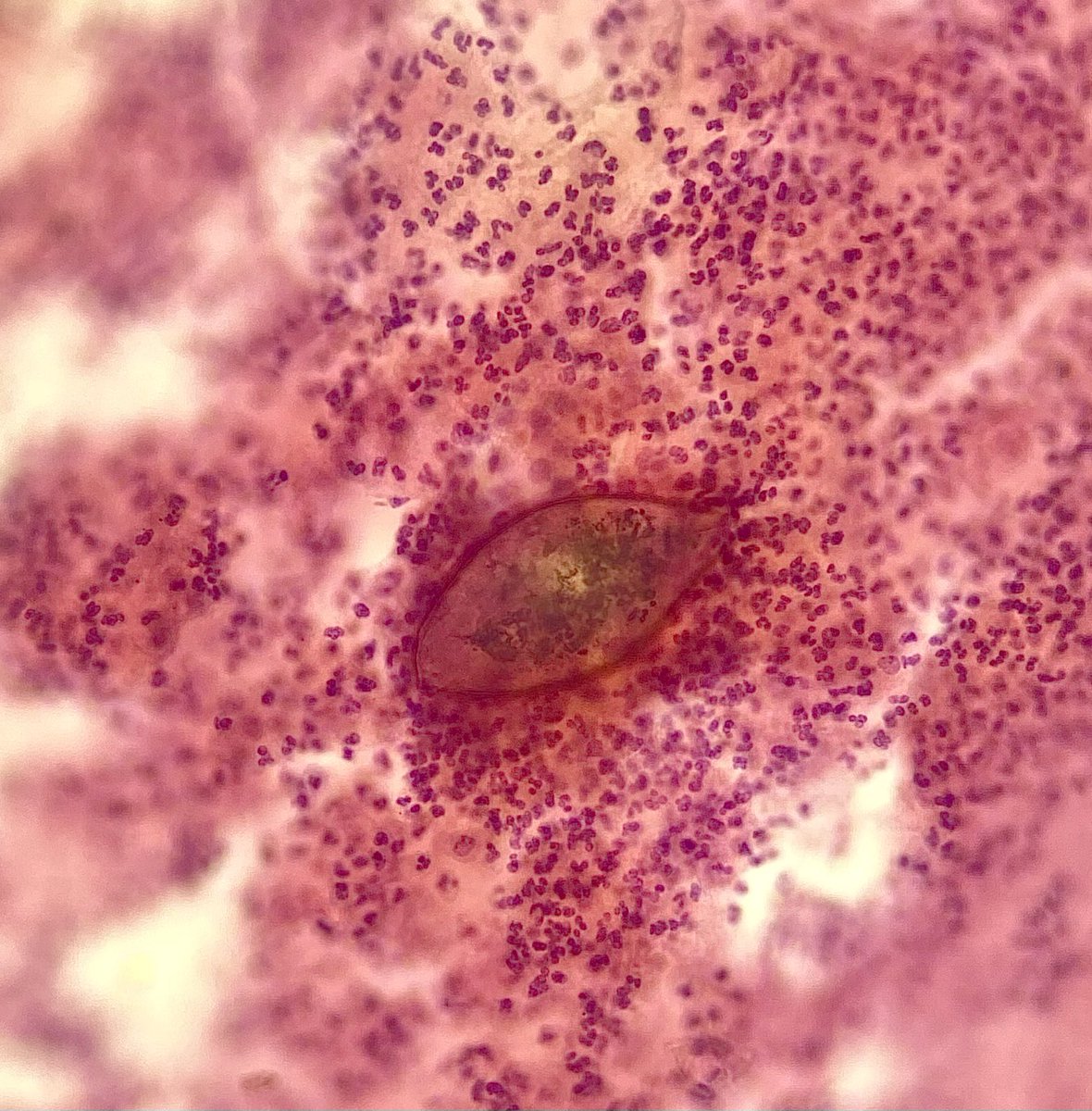 Pap smear with a difference - this infectious agent is intimately associated with neoplasia - both as a mimic and for its role in carcinogenesis. More study of this neglected tropical disease in various organs is needed #PathX #PathTwitter #schistosoma