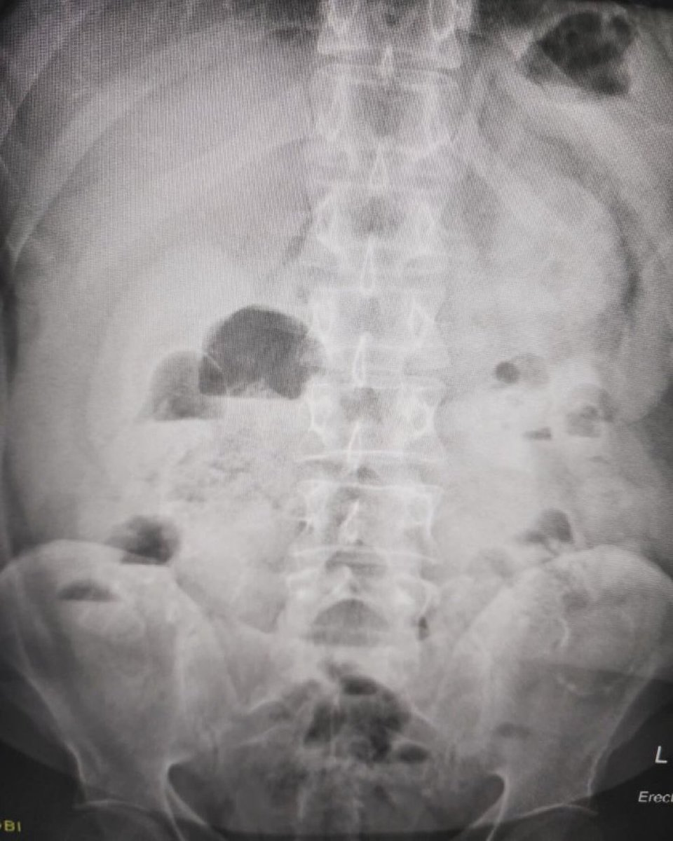 AXR of a patient with abdominal pain. What’s the diagnosis? ❤️‍🩹 I have had > 20 surgeries because of this in my life 😰 These are the complication no one warns you about after surgery - we should educate patients better to avoid them! H/T @drkeithsiau #IBD #Ostomy #Cancer