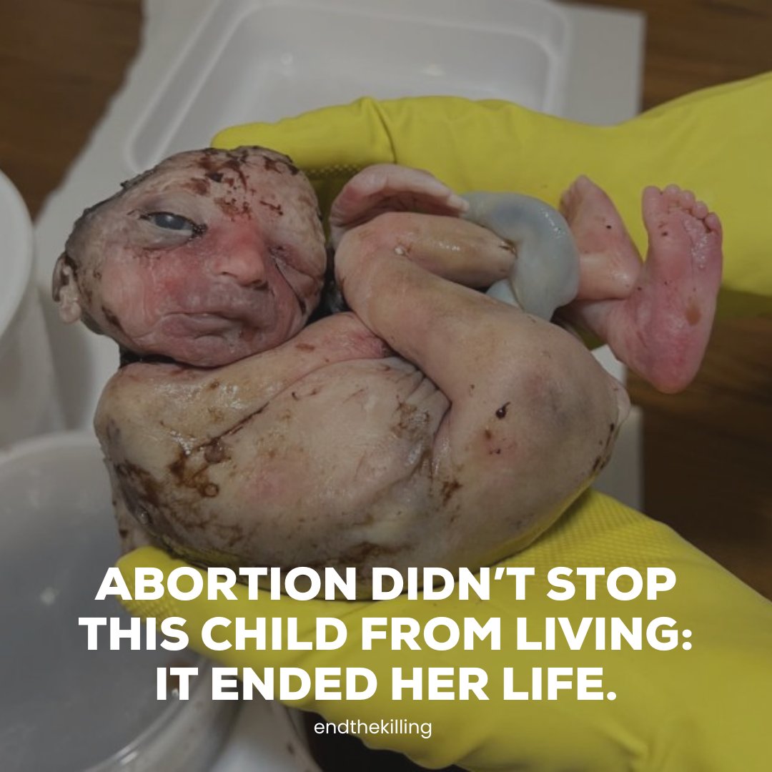 Some people believe that abortion simply stops a potential human from being able to live their life. The reality is that abortion kills a real, living, innocent boy or girl. Stand with us to end this injustice!

#endthekilling #humanrights #justice #speakup #endabortion