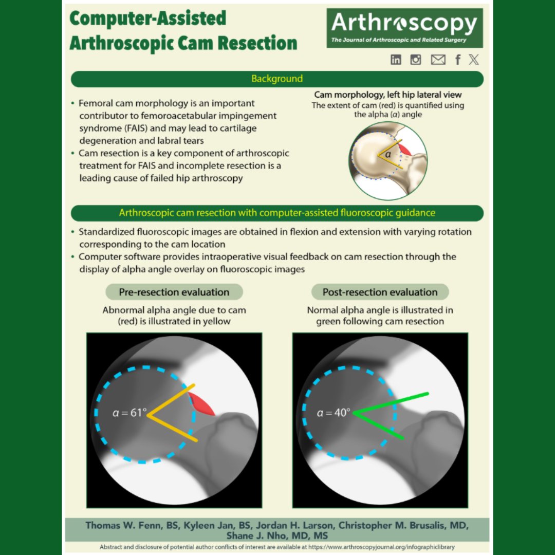'Determining the appropriate femoral CAM resection during hip arthroscopy for FAI syndrome is both critical for the patient and challenging for the surgeon.' How do you assess intraoperative alpha angle? See the attached infographic from @shanenhomd. ow.ly/7CO750RqOpc
