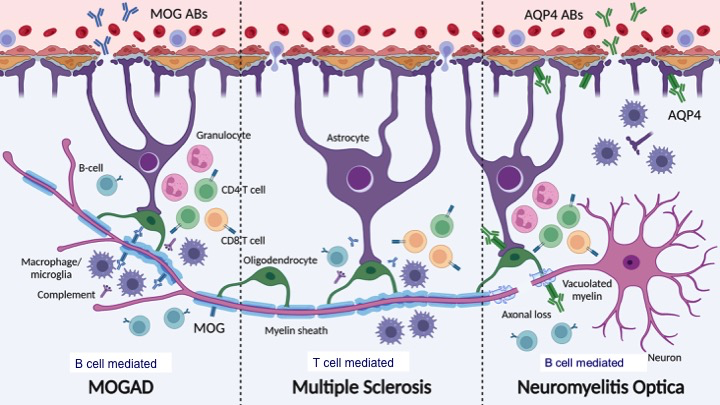 Deep dive into the pathophysiologic differences between MOGAD, NMO and MS on a cellular level with Dr. Manohar Shroff. #IPNTN #pedineurorad #neurorad