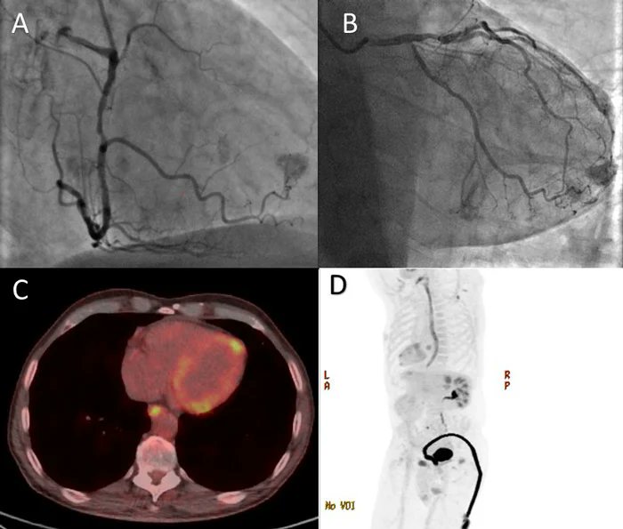 An unexpected finding on a coronary #angiography. What is your diagnosis based on this image submitted by a team from 🇬🇧 and selected for #EuroPCR. Participate in quiz here ➡️❓pcronline.com/Cases-resource… #interventionalcardiology