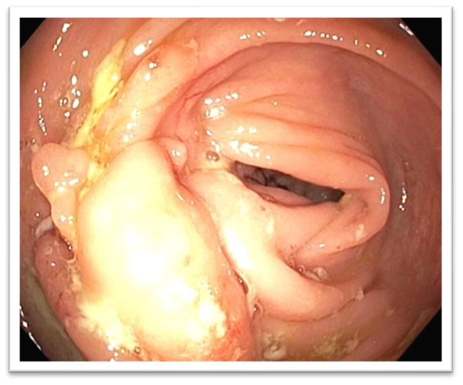IBDHorizons (@ibdhorizons) on Twitter photo #IBDHorizons24 Barahimi <a href="/FezaRemziMD/">Dr Feza Remzi</a>
Case:
36yo F with stricture, upstream dilation & abscess on CT.
🩻F/u CT: abscess resolution with antibiotics
🥗mild pain with eating, no fever.
🔦Endoscopy: no other areas of CD inflammation but non-traversable ileal stricture
🤔next steps? #IBDHorizons24 Barahimi <a href="/FezaRemziMD/">Dr Feza Remzi</a>
Case:
36yo F with stricture, upstream dilation & abscess on CT.
🩻F/u CT: abscess resolution with antibiotics
🥗mild pain with eating, no fever.
🔦Endoscopy: no other areas of CD inflammation but non-traversable ileal stricture
🤔next steps?