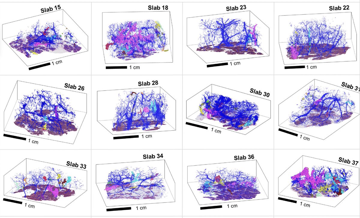 Why 3D omic and not simply 2D omic? Our recent paper determines the number of spatially distinct precursor lesions, their morphology and mutational profile. None of this can be done in 2D. And only CODA can do it. nature.com/articles/s4158… Also: biorxiv.org/content/10.110…