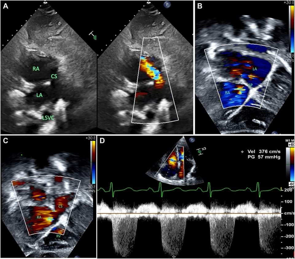 🔴 Dx of Unroofed Coronary Sinus in the Adult #OpenAccess #2024Review 

A rare cause of atrial-level shunting & right heart dilatation.

TTE is the primary modality to diagnose unroofed CS.

CCT &/or MRI should be  complementary study before repair
bit.ly/3v1Wca2