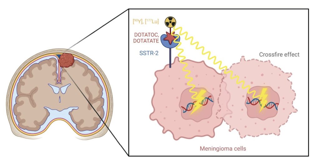 Radioligand therapies in meningioma – evidence and future directions.

academic.oup.com/neuro-oncology…

#btsm #theranostics #meningioma @MJ_Mair @ProfNAlbert @NeuroOnc @OncoAlert @EORTC