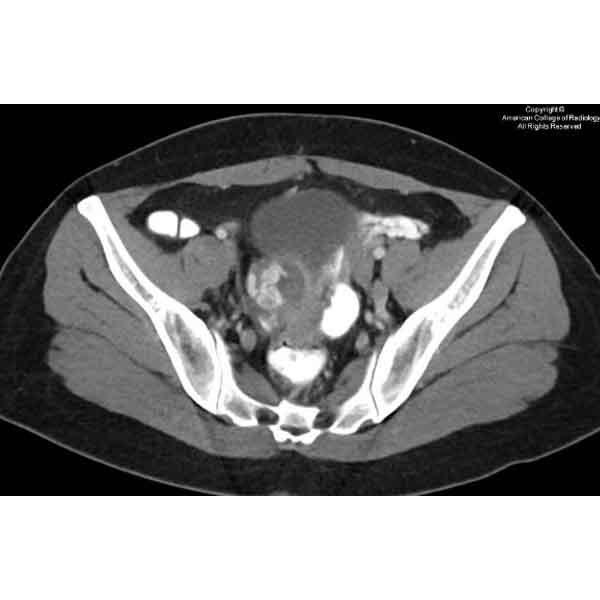 A 30-year-old woman with presumed ectopic pregnancy status post methotrexate treatment presents with persistent vaginal bleeding…#ACRCaseinPoint bit.ly/49WqKs2