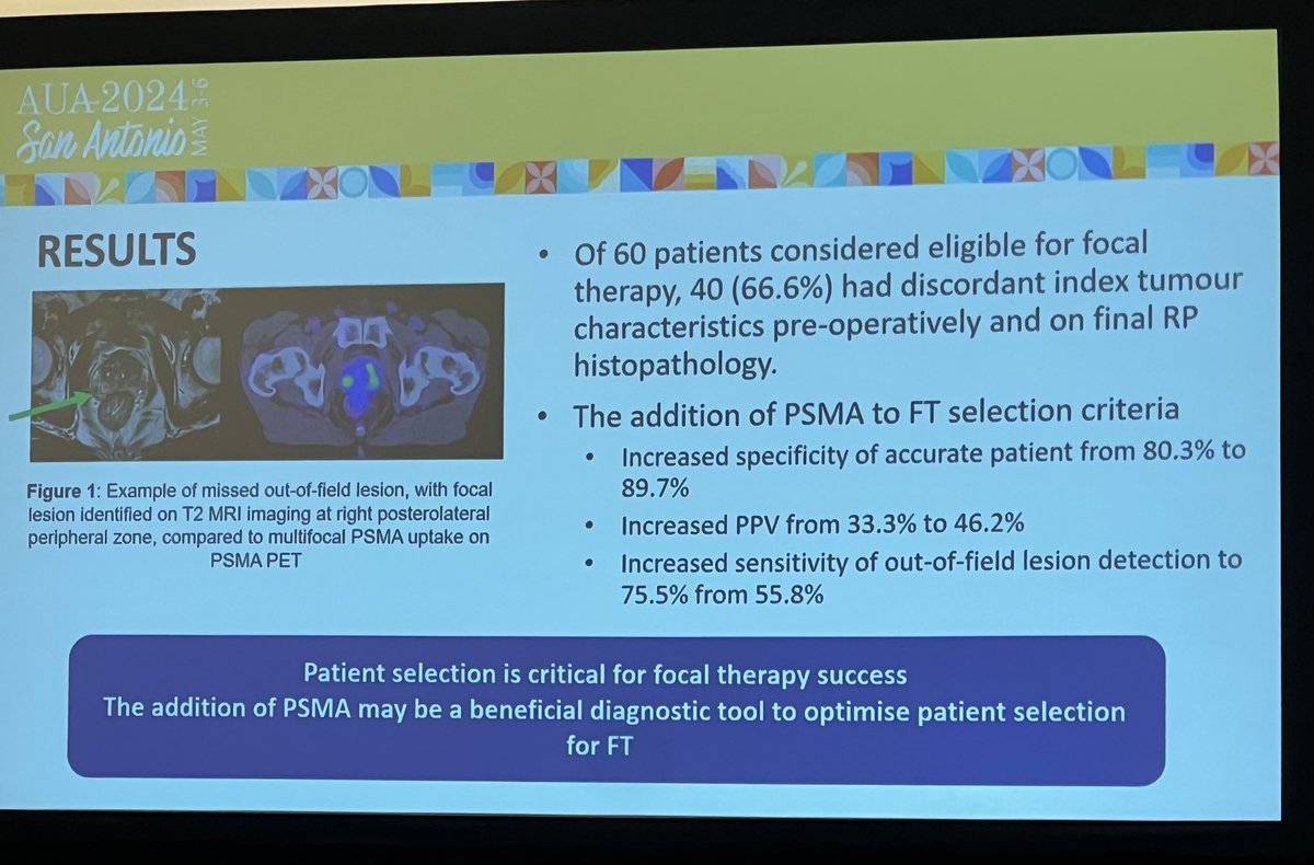 Bilateral grade group 2 disease is common: > 50% of theoretical focal candidates had disease not suitable for focal therapy. #AUA24